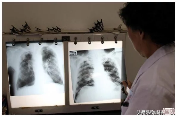 胸片全体曝光:揭示医疗影像背后的隐私问题与伦理挑战,呼吁加强对患者信息的保护和管理 胸片全体曝光:揭示医疗影像背后的隐私问题与伦理挑战,呼吁加强对患者信息的保护和管理